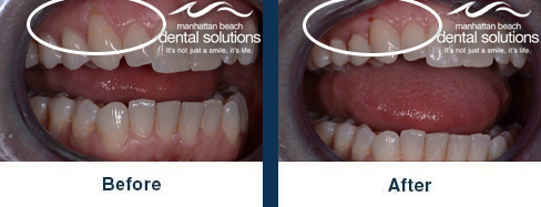 Gum Rejuvenation Before & After Results