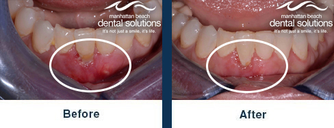 Gum Rejuvenation Before & After Results