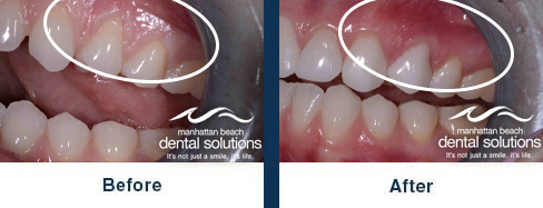 Veneers & Gum Rejuvenation Before & After Results