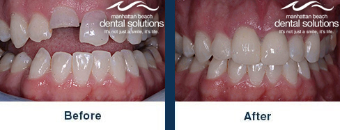 Porcelain Crowns Before & After Results