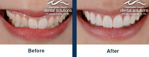 Same-Day Veneers Before & After Results