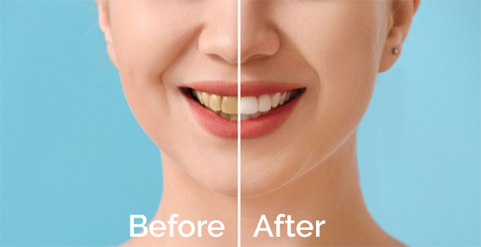 Smile Makeover Cost