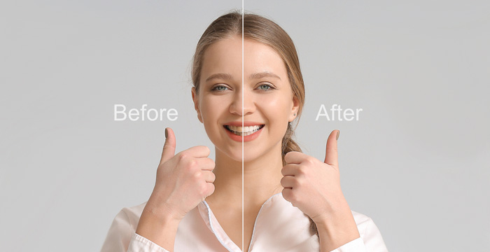 Smile Makeover Candidate - Manhattan Beach Dental Solutions, CA