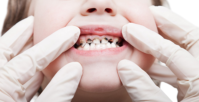Tooth Decay - Manhattan Beach Dental Solutions, CA