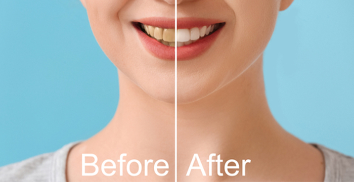 Smile Makeover FAQ - Manhattan Beach Dental