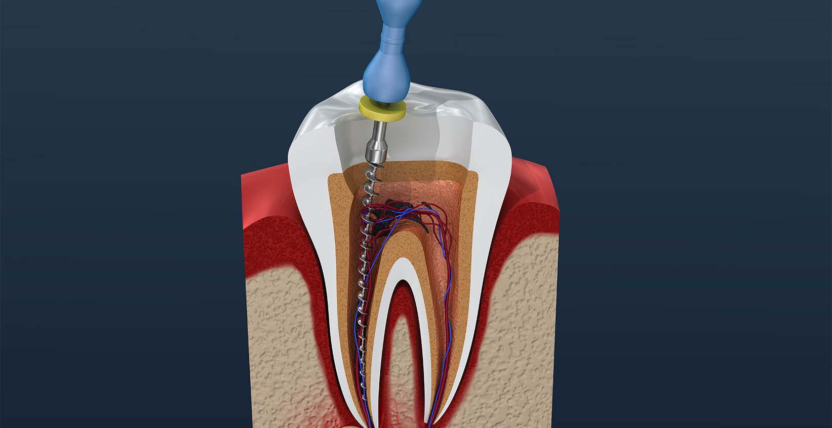 Root Canal Infection Symptoms in Manhattan Beach CA Area